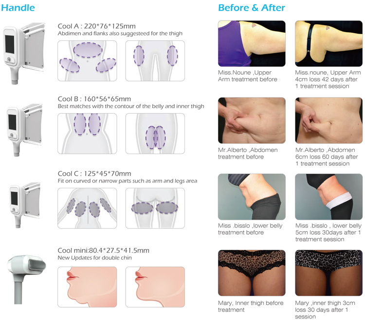 Factory Direct Supply Cryolipolysis Slimming Machine with OEM/ODM Service