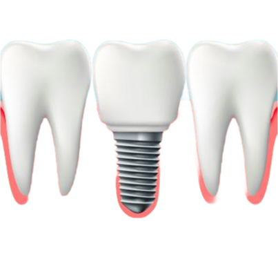 Customizable Titanium Dental Implants with Reverse Taper Straight Taper Design