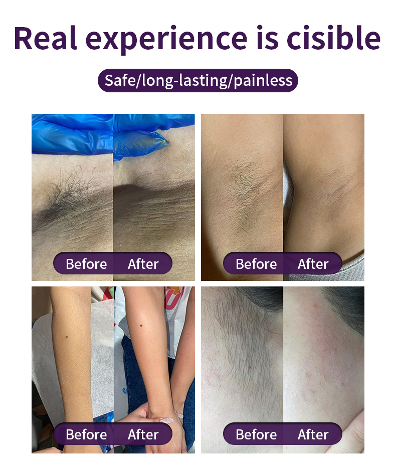 Professional 808nm Diode Laser Hair Removal System with Multi-Spot Size and TEC Cooling Technology