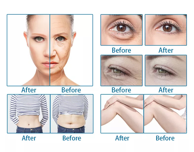 2000 Shots Portable No-Needle Hifu Beauty Device – China Factory Direct, OEM Available, 1.5-13mm Cartridges, CE Certified
